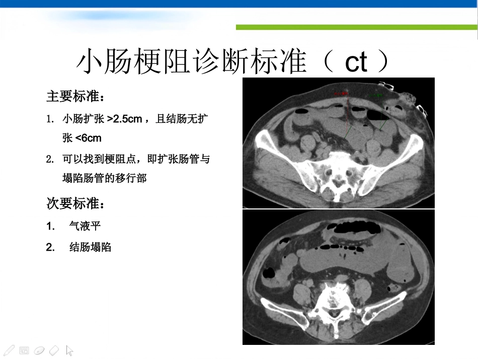 肠梗阻的影像诊断肠梗阻的影像分析_第11页