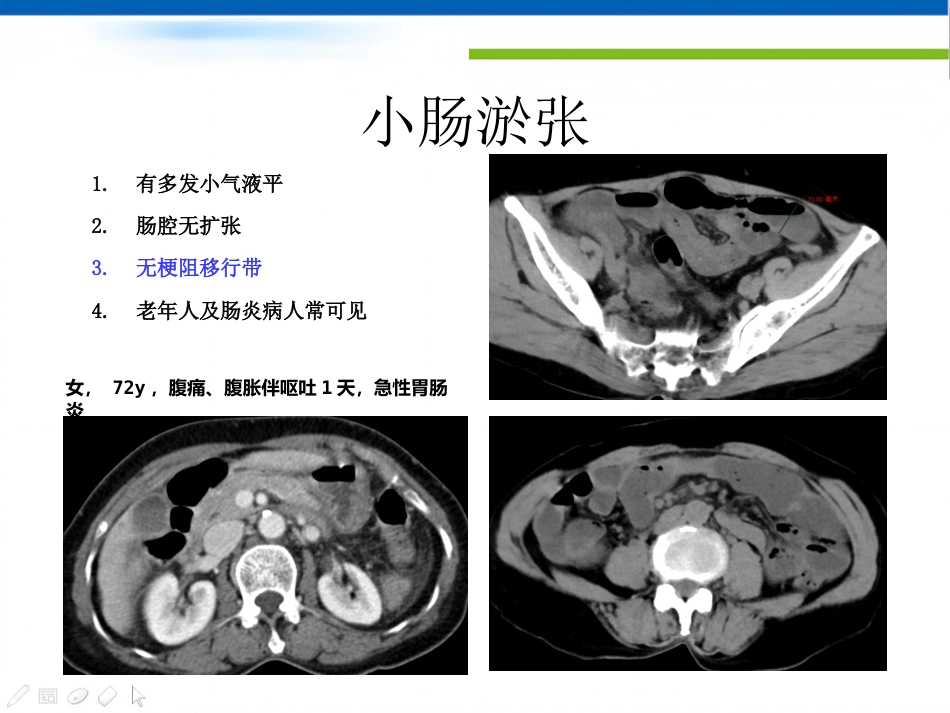 肠梗阻的影像诊断肠梗阻的影像分析_第12页