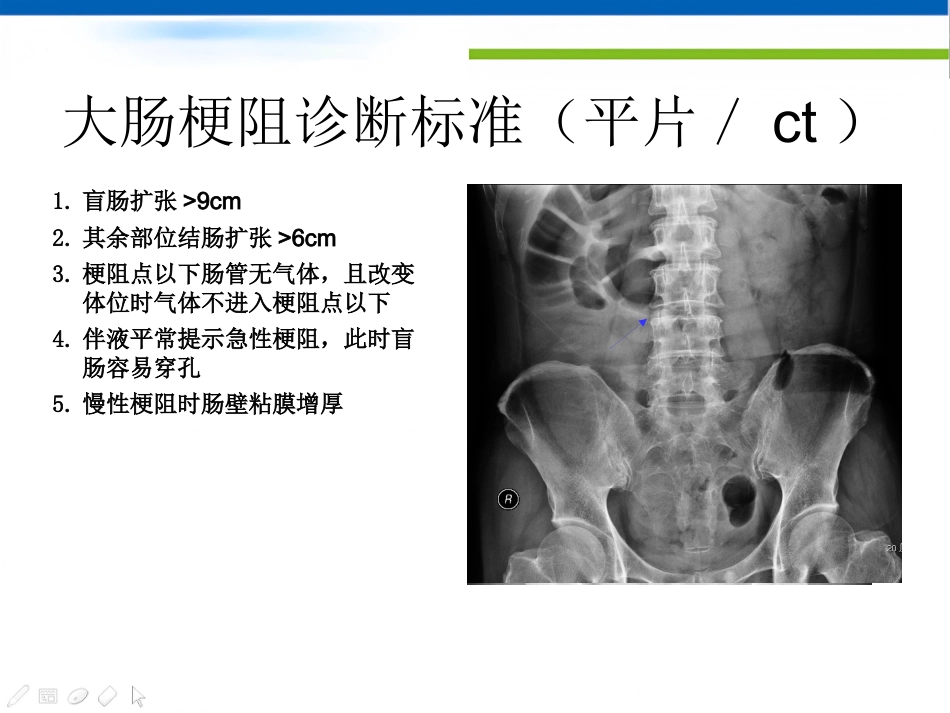 肠梗阻的影像诊断肠梗阻的影像分析_第13页