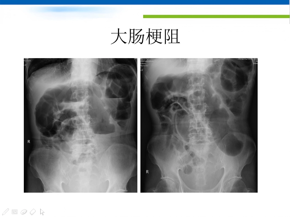 肠梗阻的影像诊断肠梗阻的影像分析_第14页