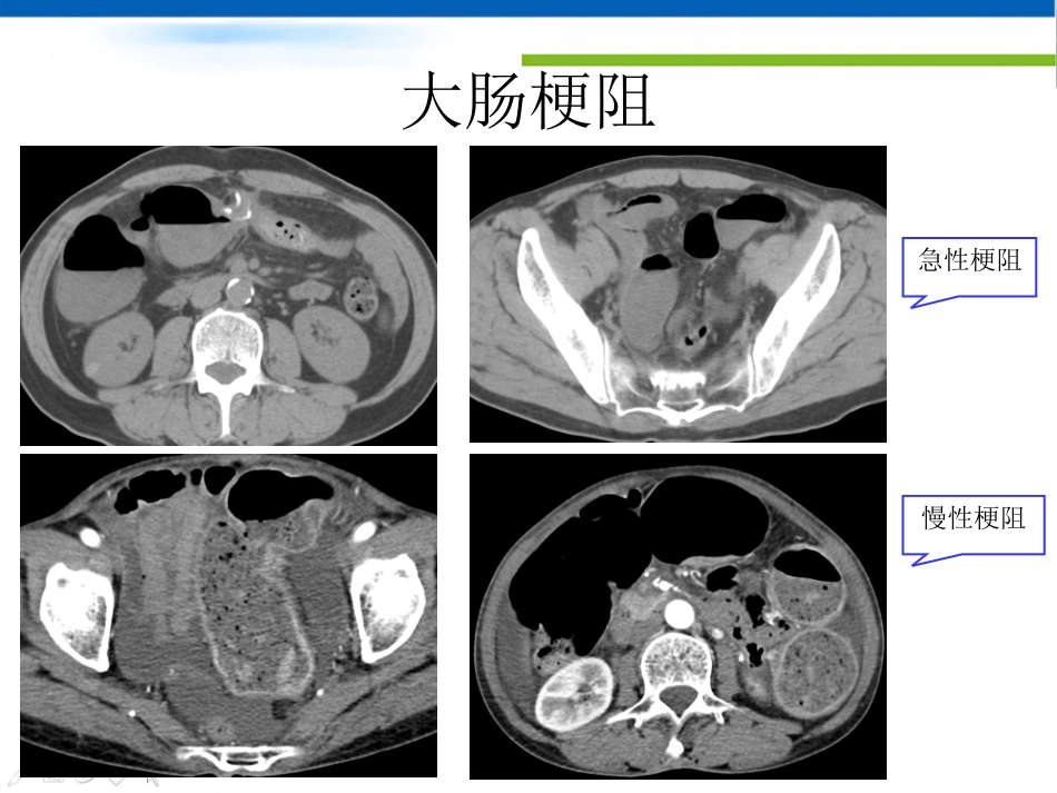肠梗阻的影像诊断肠梗阻的影像分析_第15页