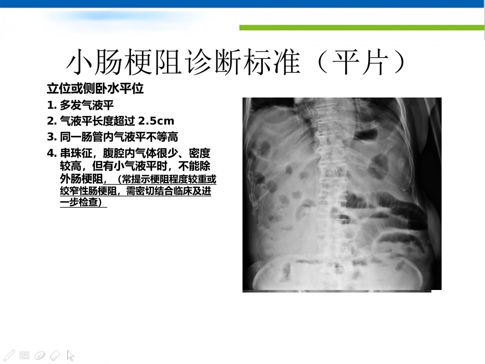 肠梗阻的影像诊断肠梗阻的影像分析_第9页