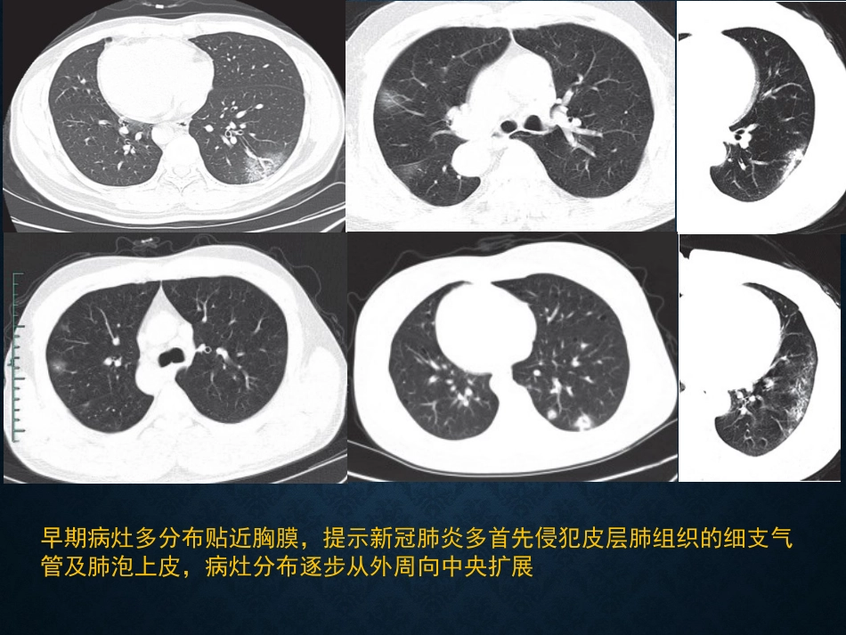 病毒性肺炎影像_第10页