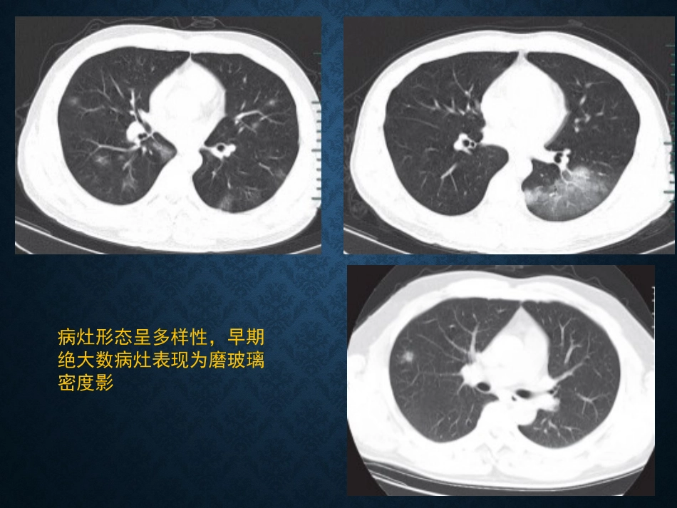 病毒性肺炎影像_第11页