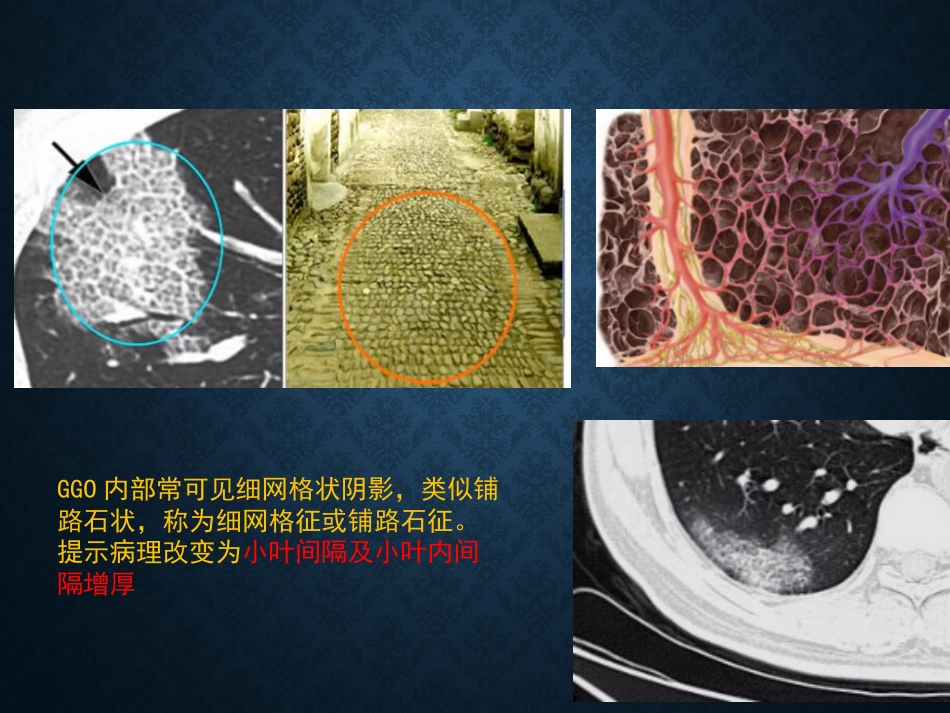 病毒性肺炎影像_第12页