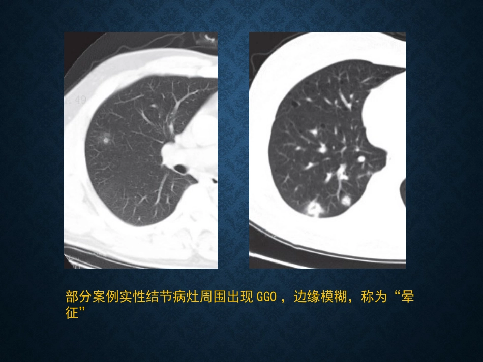 病毒性肺炎影像_第13页