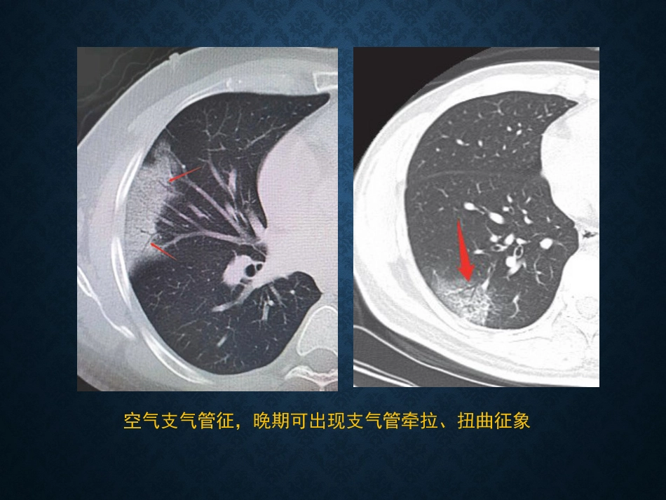 病毒性肺炎影像_第14页