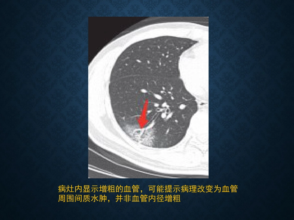 病毒性肺炎影像_第15页