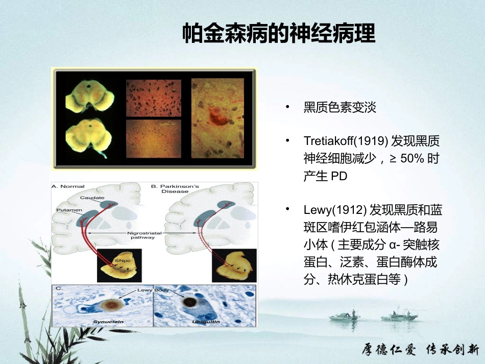 帕金森病诊断和鉴别诊断_第11页