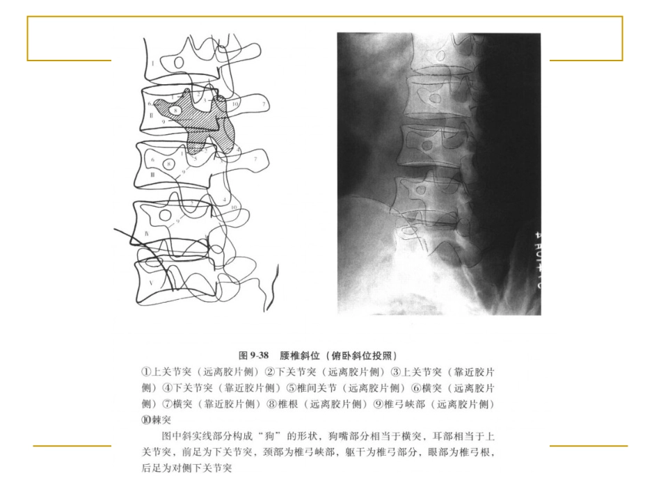 外影像与诊断学：脊柱x片诊断_第13页