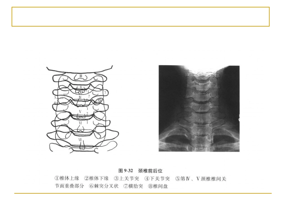 外影像与诊断学：脊柱x片诊断_第6页