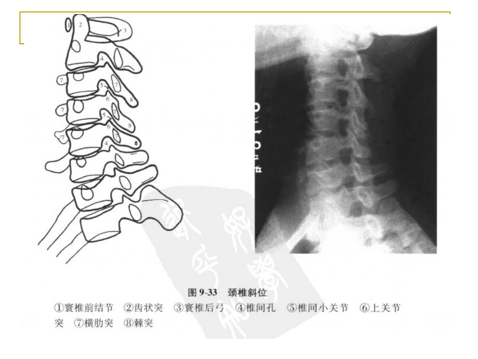 外影像与诊断学：脊柱x片诊断_第8页