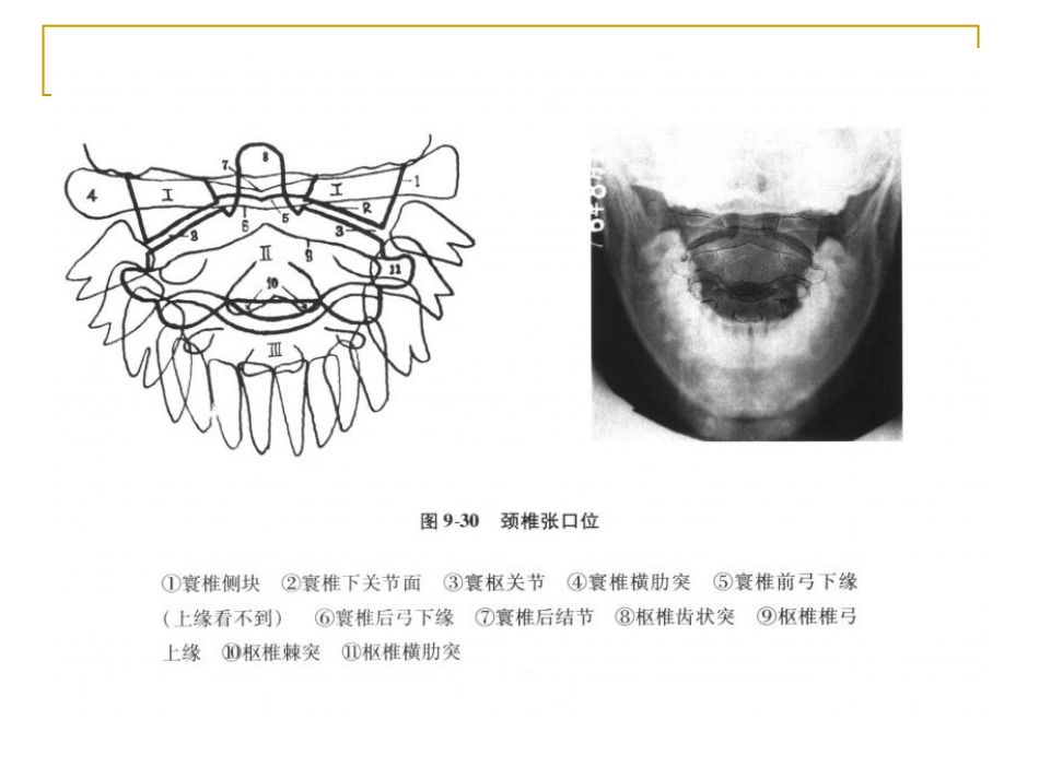 外影像与诊断学：脊柱x片诊断_第9页