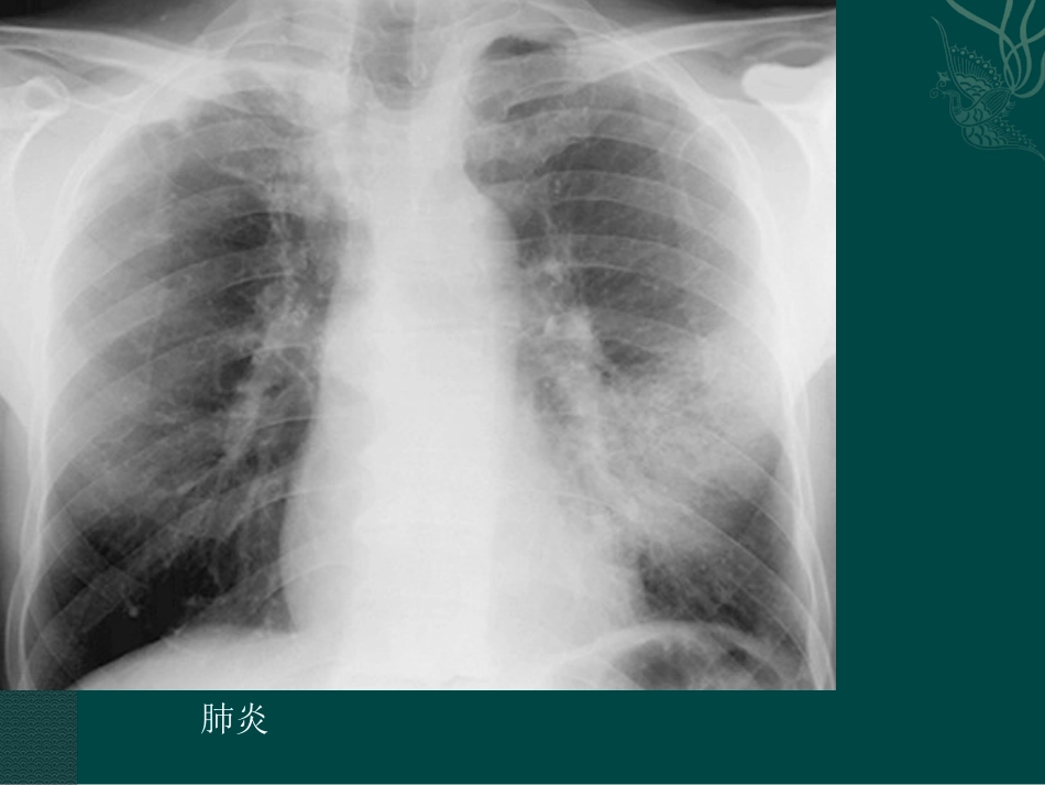 常见呼吸系统疾病影像诊断_第6页