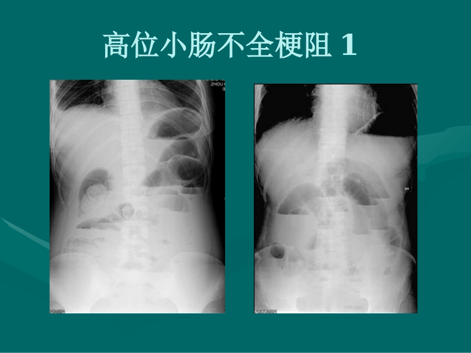 肠梗阻-影像诊断_第13页