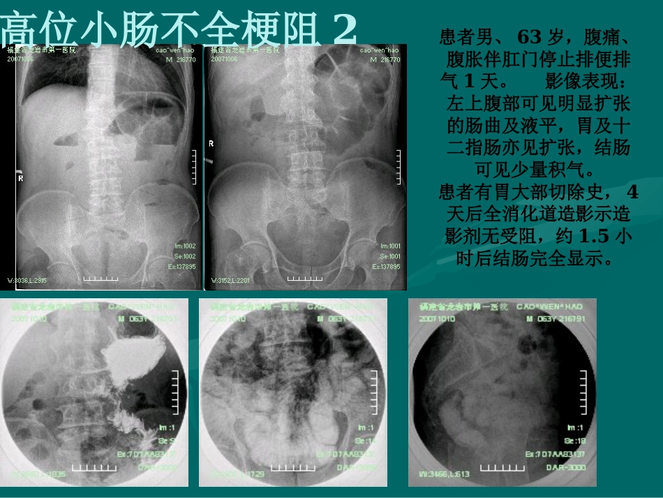 肠梗阻-影像诊断_第14页