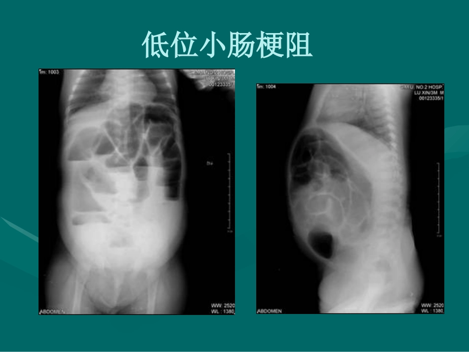 肠梗阻-影像诊断_第15页