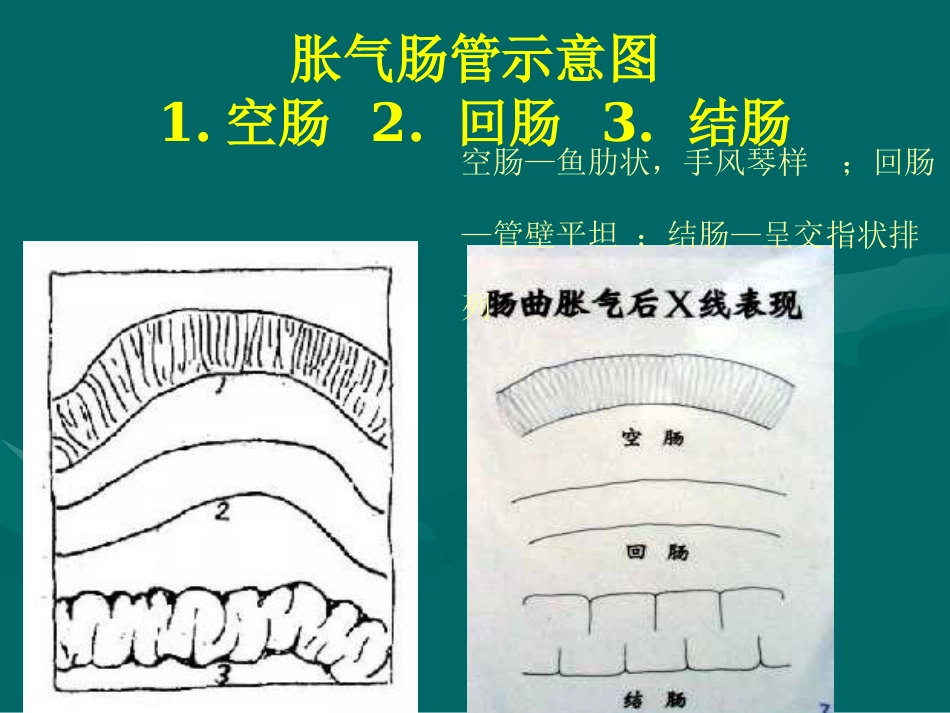 肠梗阻-影像诊断_第9页
