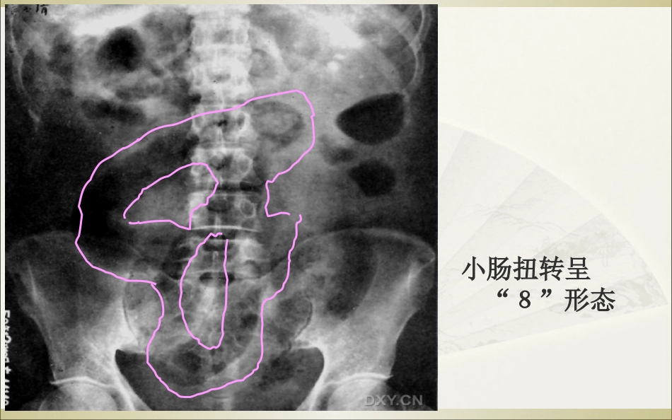 肠梗阻的影像诊断_第12页