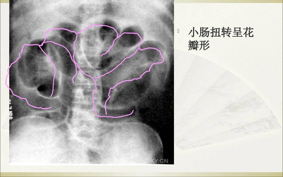 肠梗阻的影像诊断_第13页