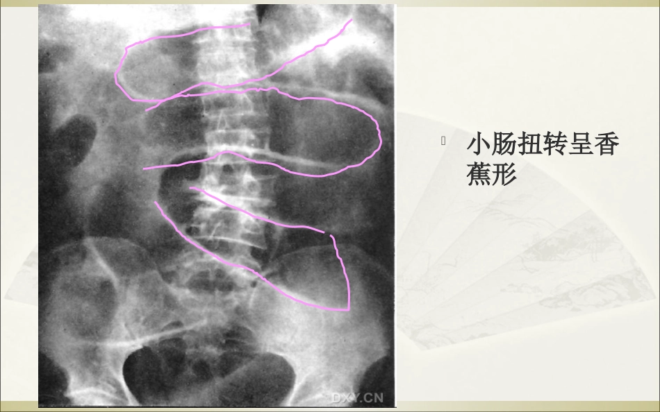 肠梗阻的影像诊断_第14页