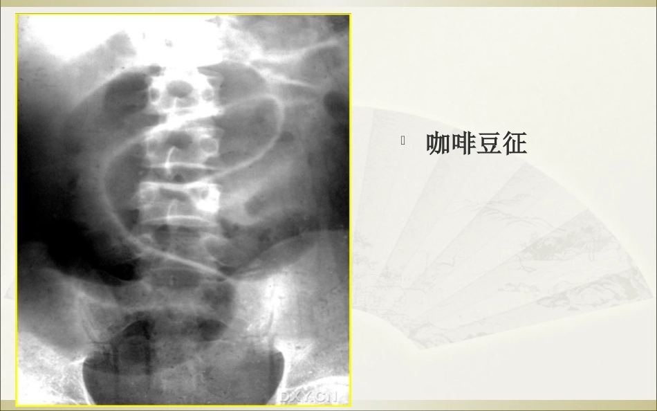 肠梗阻的影像诊断_第15页