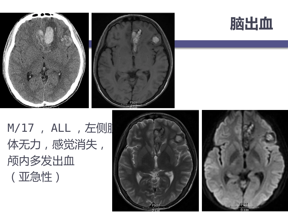 白血病中枢神经系统并发症的影像学诊断_第10页