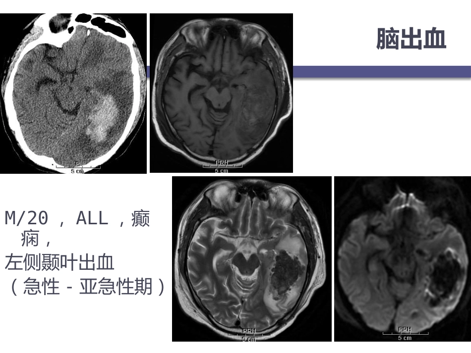 白血病中枢神经系统并发症的影像学诊断_第11页