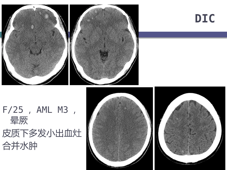 白血病中枢神经系统并发症的影像学诊断_第12页