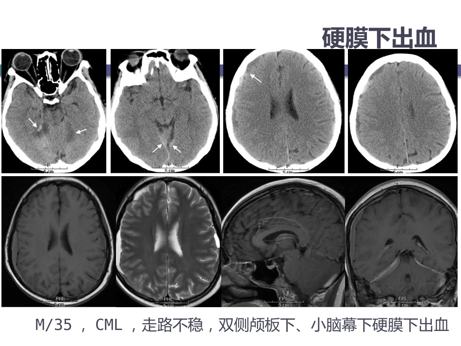 白血病中枢神经系统并发症的影像学诊断_第13页