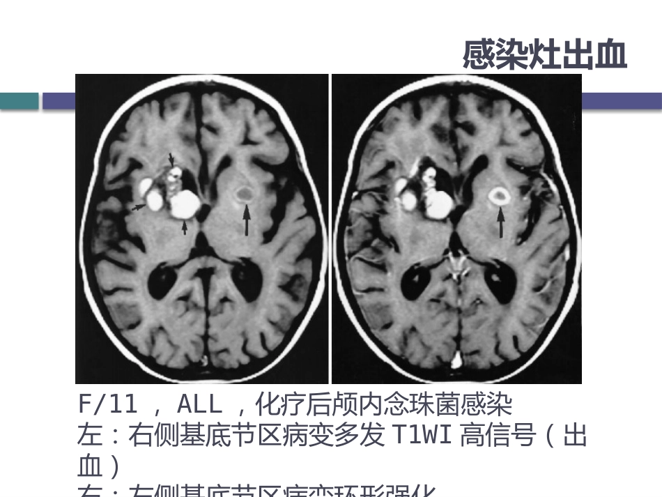 白血病中枢神经系统并发症的影像学诊断_第14页
