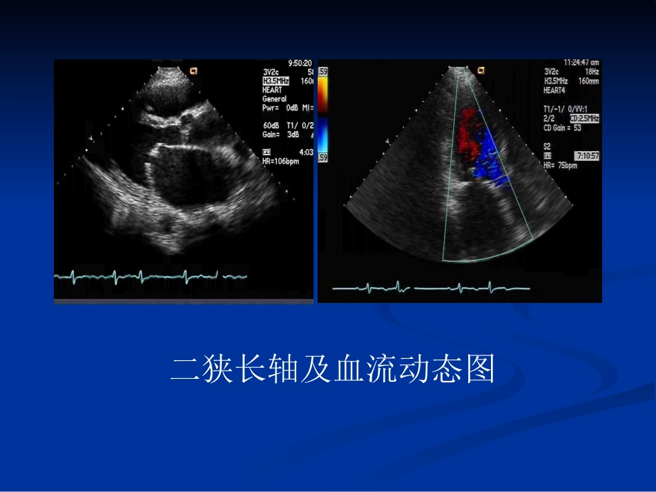 心脏瓣膜病的超声诊断_第12页