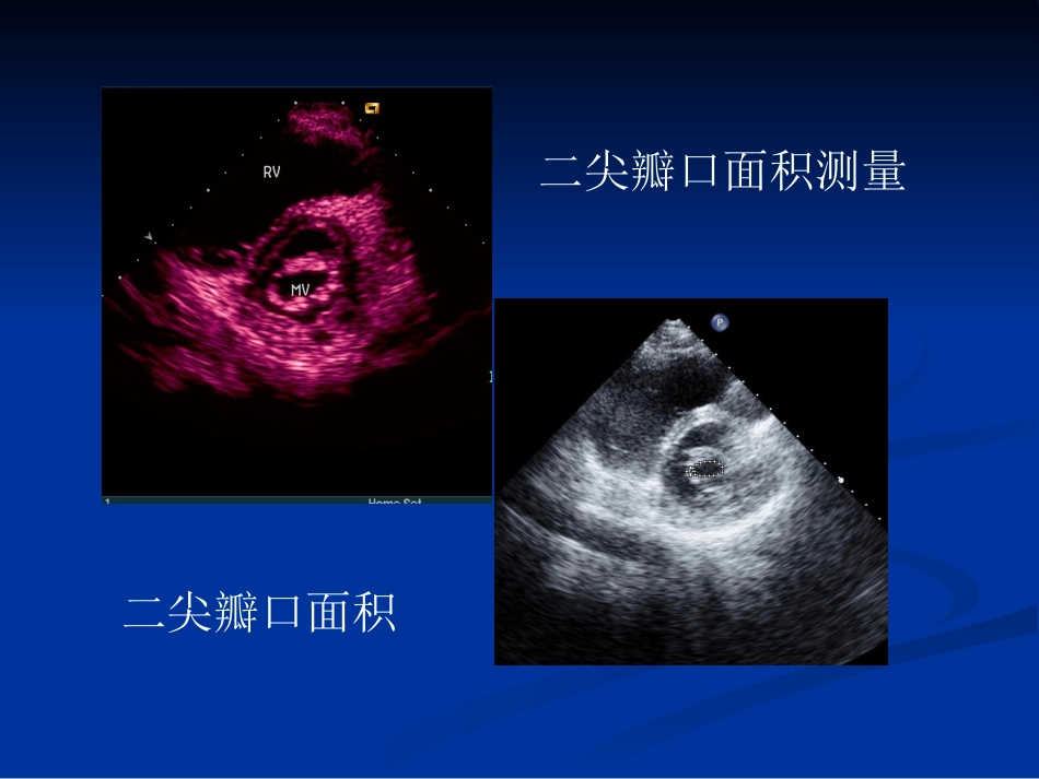 心脏瓣膜病的超声诊断_第5页