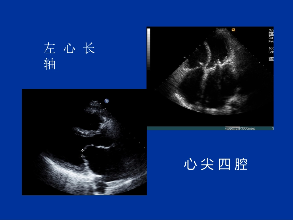 心脏瓣膜病的超声诊断_第7页