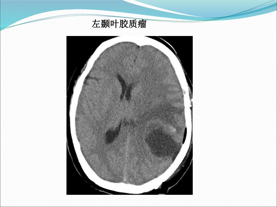 常见脑肿瘤的影像诊断_第12页
