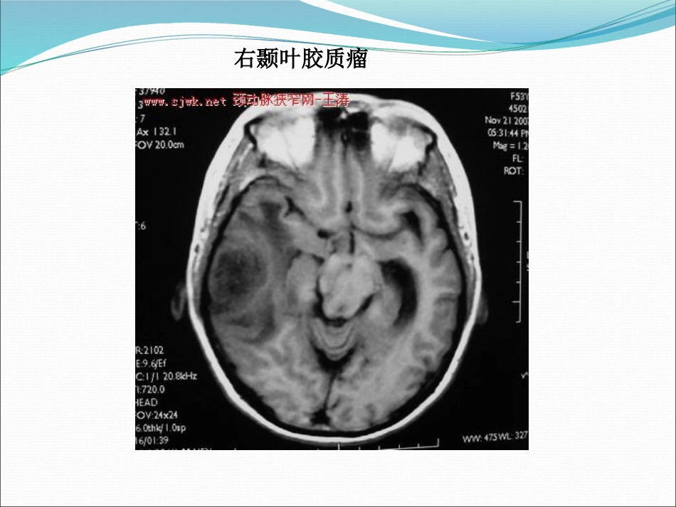 常见脑肿瘤的影像诊断_第13页