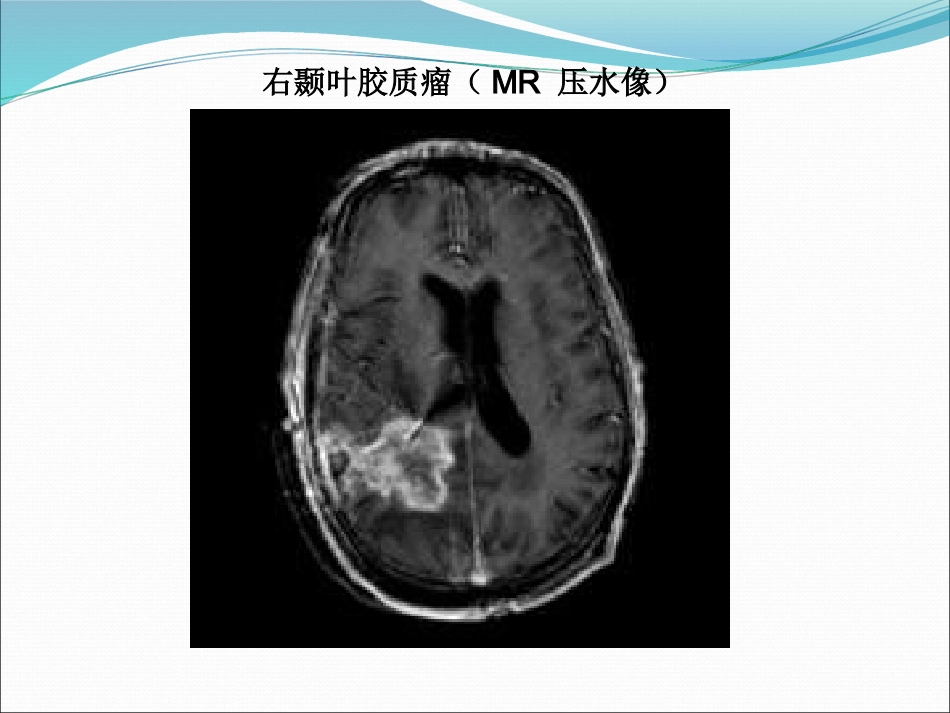 常见脑肿瘤的影像诊断_第14页
