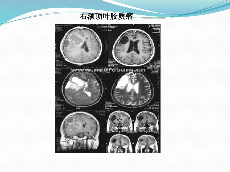 常见脑肿瘤的影像诊断_第15页