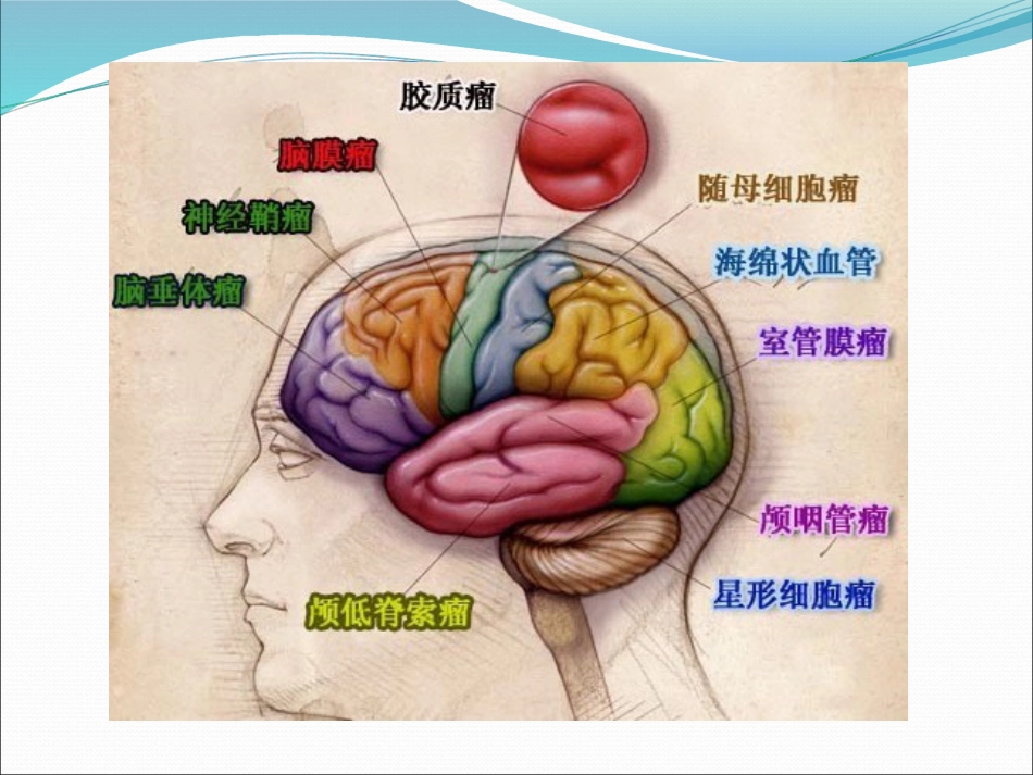 常见脑肿瘤的影像诊断_第2页