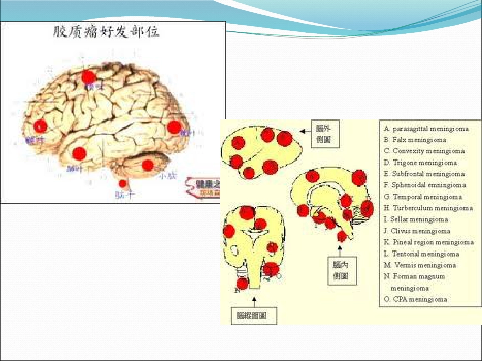 常见脑肿瘤的影像诊断_第4页