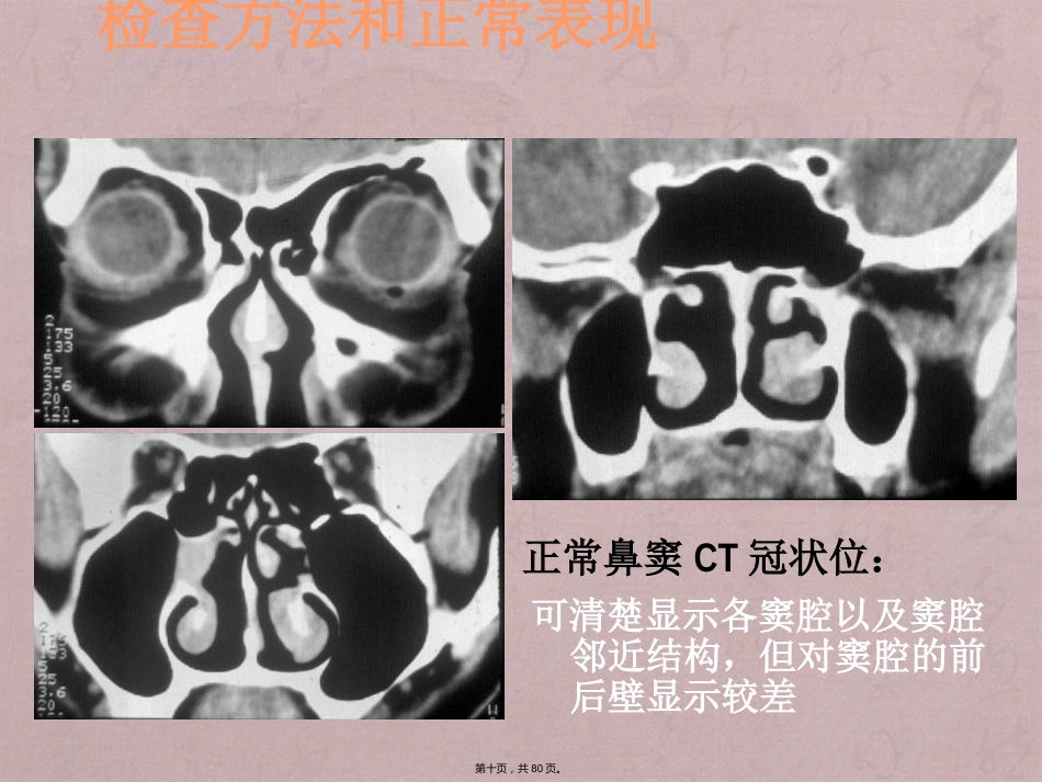 鼻窦影像诊断_第10页