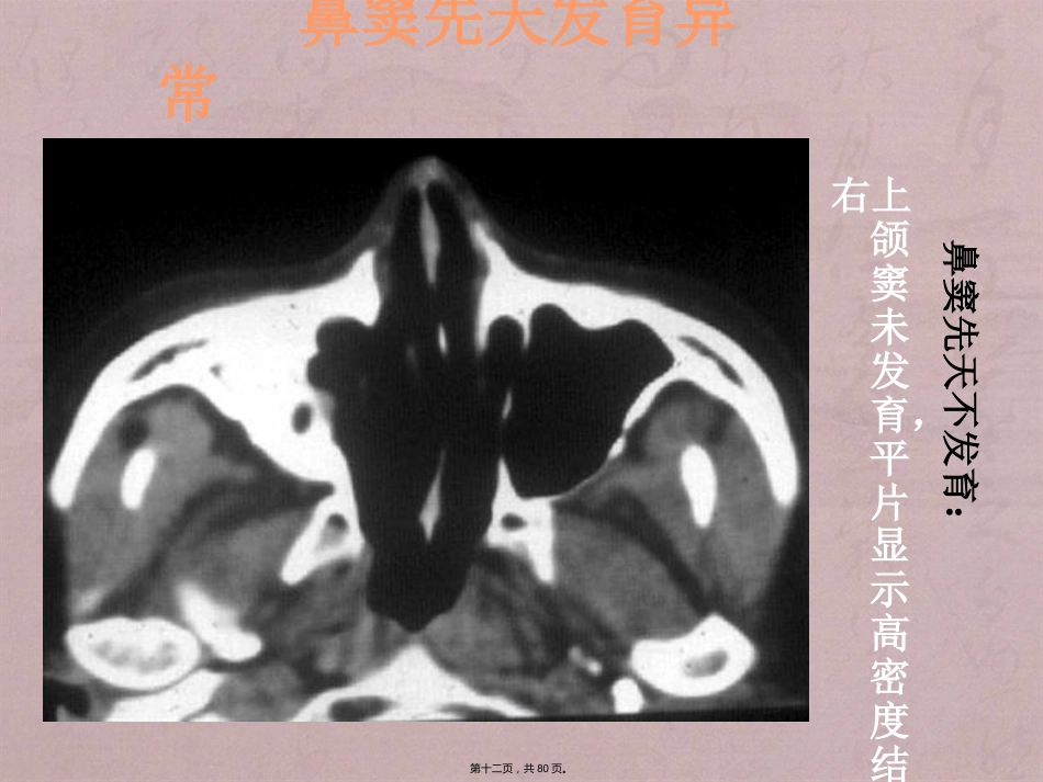 鼻窦影像诊断_第12页