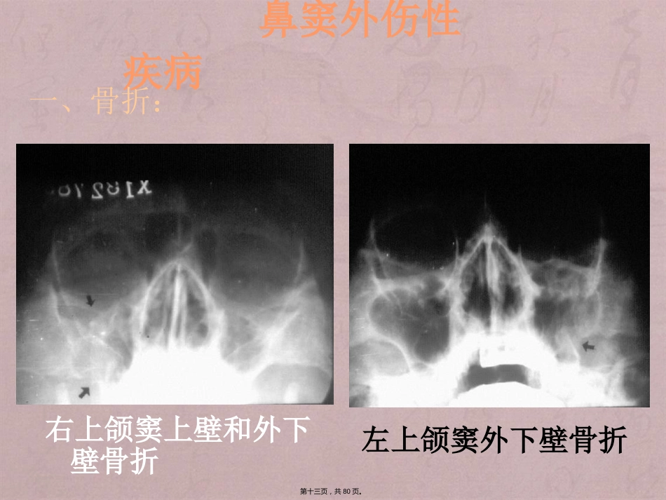 鼻窦影像诊断_第13页