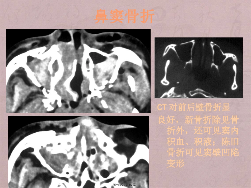 鼻窦影像诊断_第14页