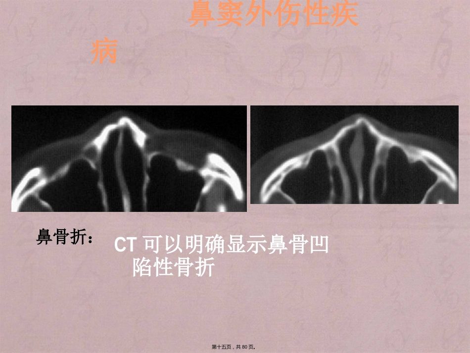 鼻窦影像诊断_第15页