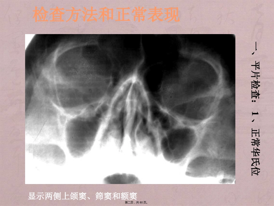鼻窦影像诊断_第2页