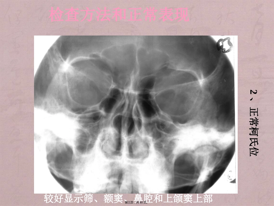 鼻窦影像诊断_第3页