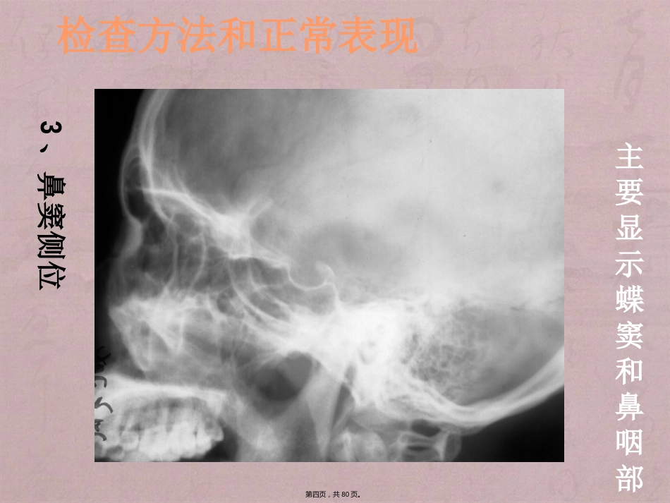 鼻窦影像诊断_第4页
