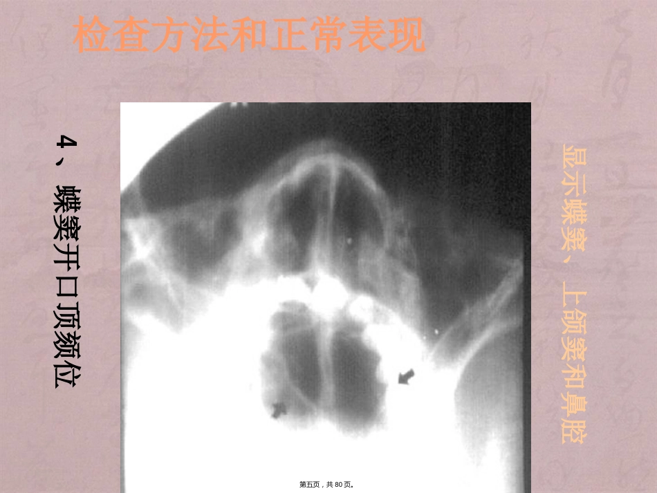 鼻窦影像诊断_第5页