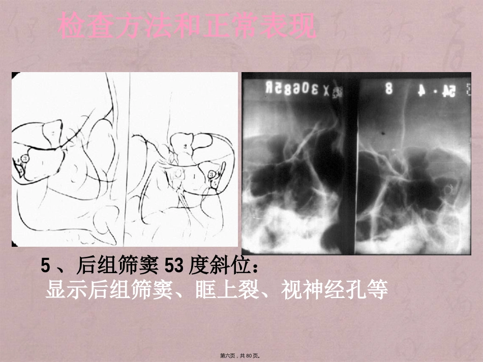 鼻窦影像诊断_第6页